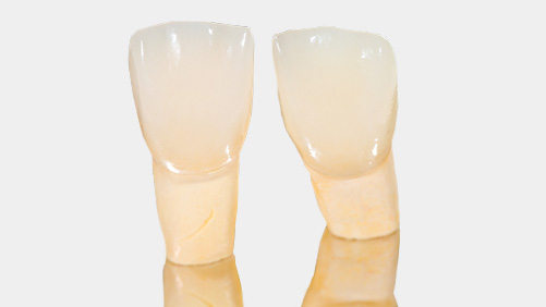 Veneers